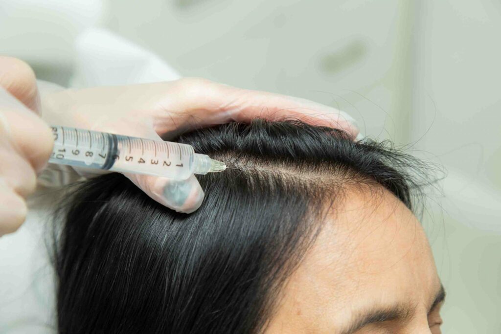 Carboxiterapia no cabelo